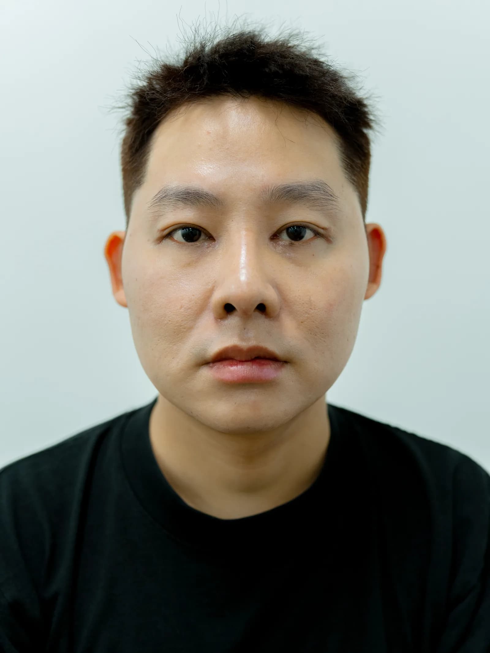 Rhinoplasty (male patient) — at the follow-up visit