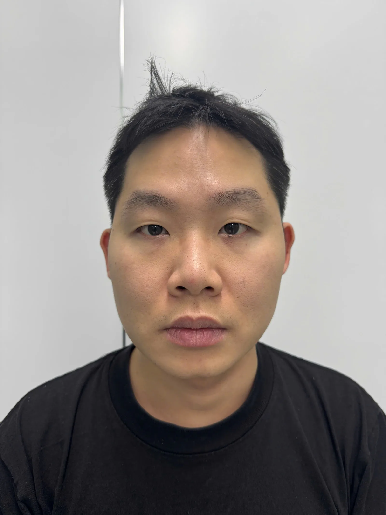 Rhinoplasty (male patient) — before