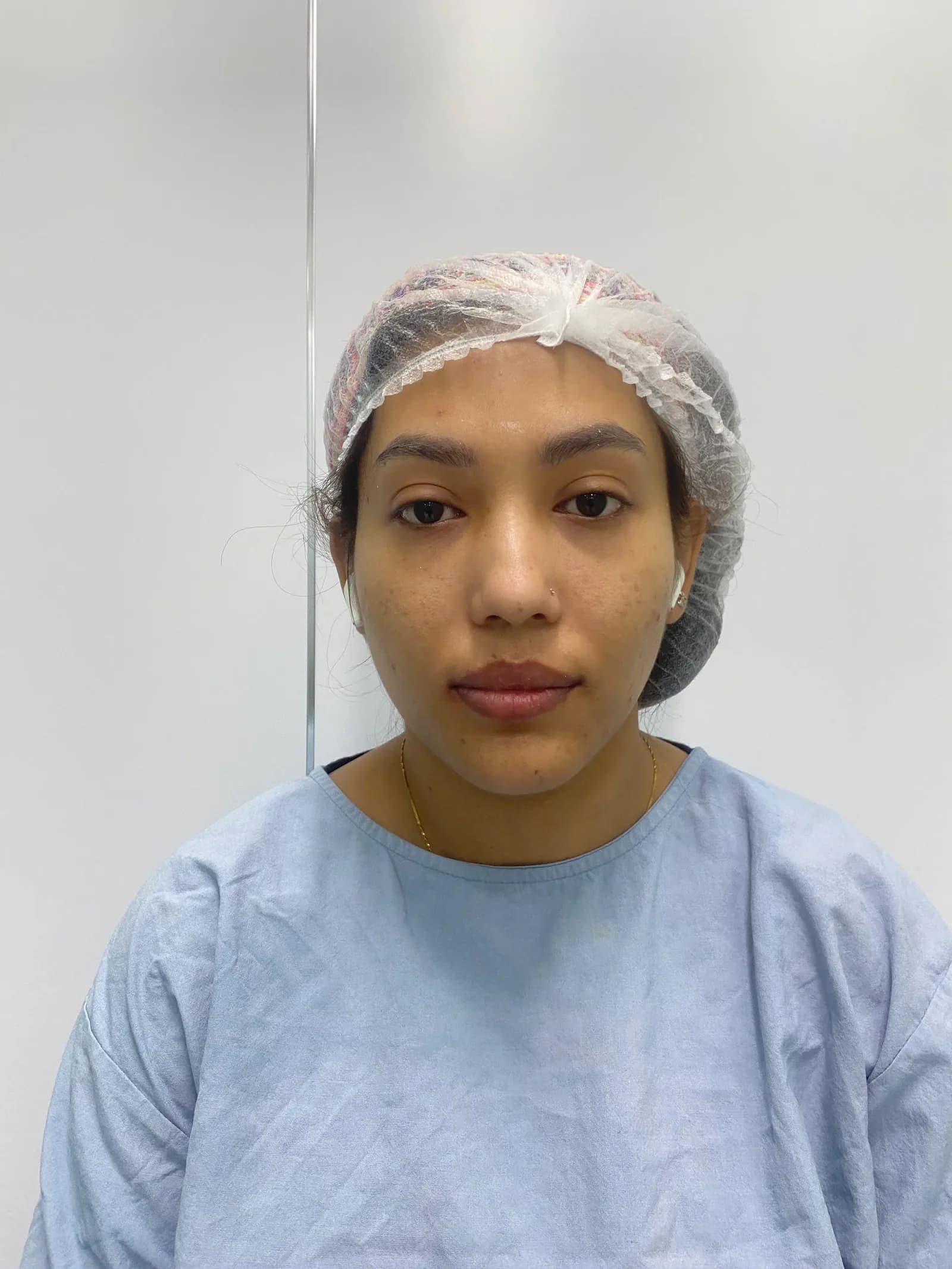 Revision rhinoplasty — before