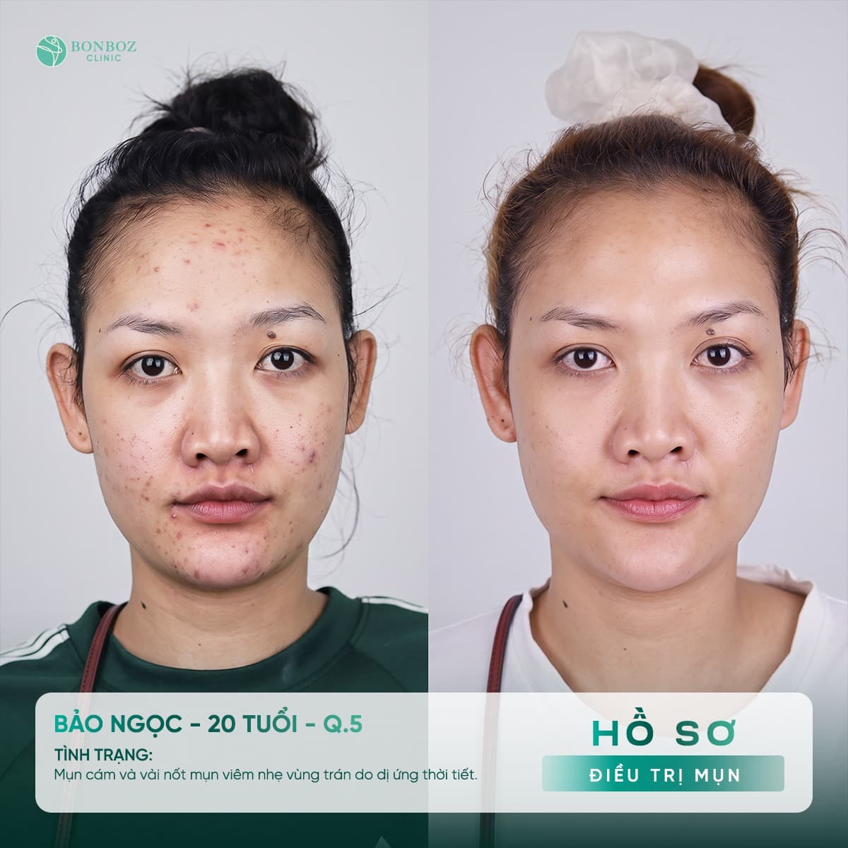 Hồ sơ điều trị mụn — Bảo Ngọc, 20 tuổi
