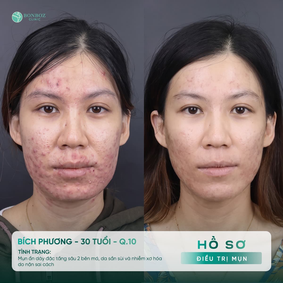 Hồ sơ điều trị mụn — Bích Phương, 30 tuổi