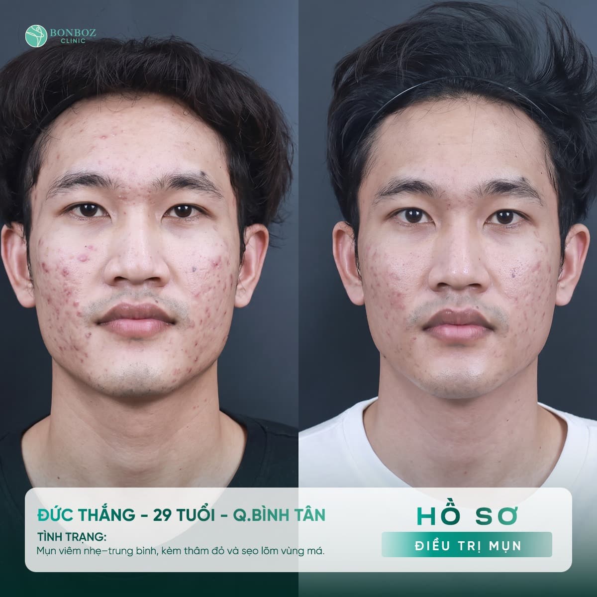 Hồ sơ điều trị mụn — Đức Thắng, 29 tuổi