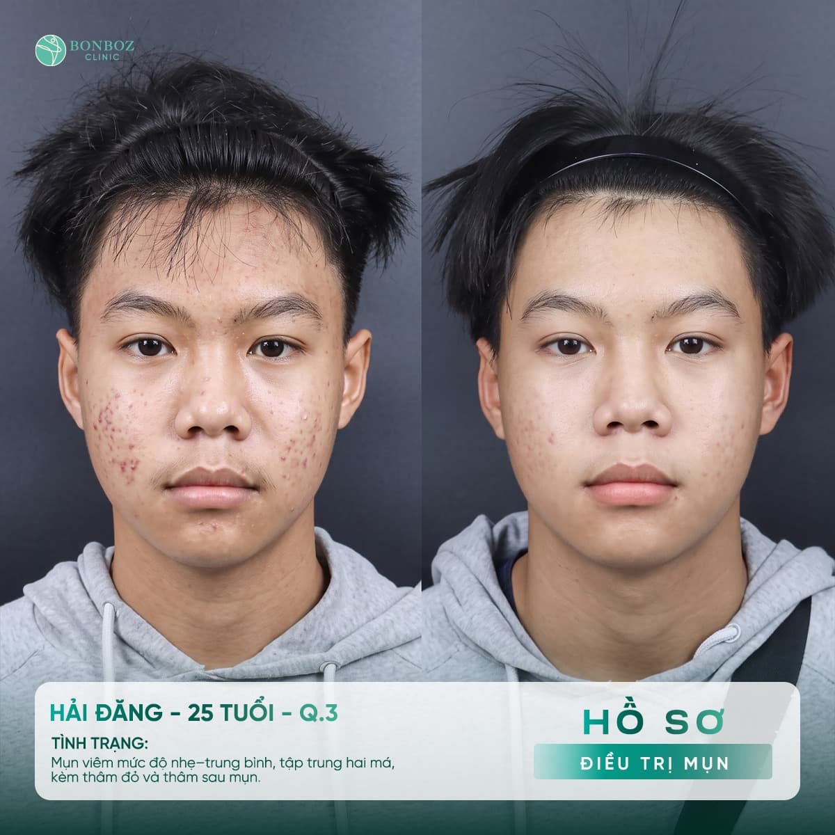 Hồ sơ điều trị mụn — Hải Đăng, 25 tuổi
