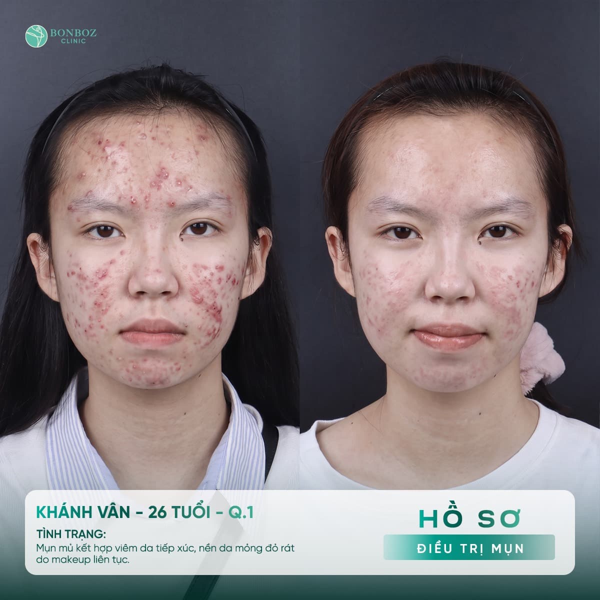Hồ sơ điều trị mụn — Khánh Vân, 26 tuổi
