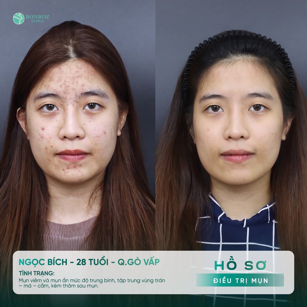 Hồ sơ điều trị mụn — Ngọc Bích, 28 tuổi