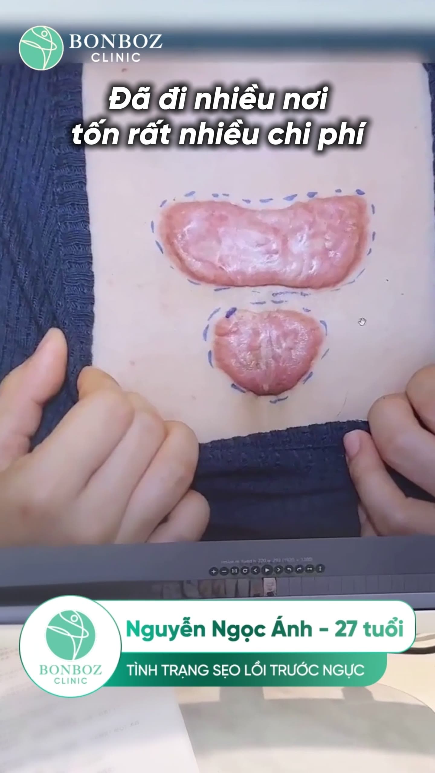 Video điều trị 03