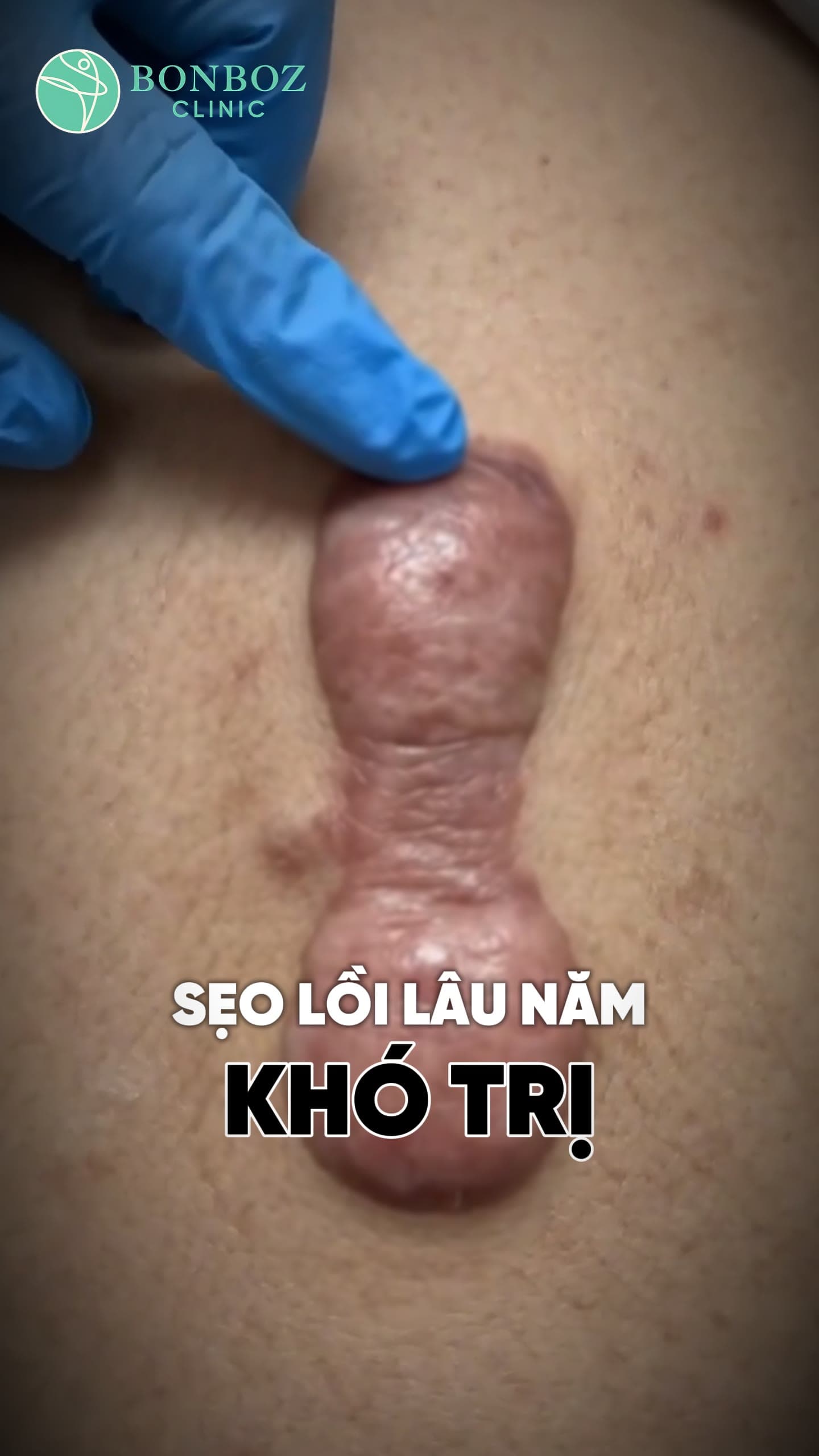 Video điều trị 05