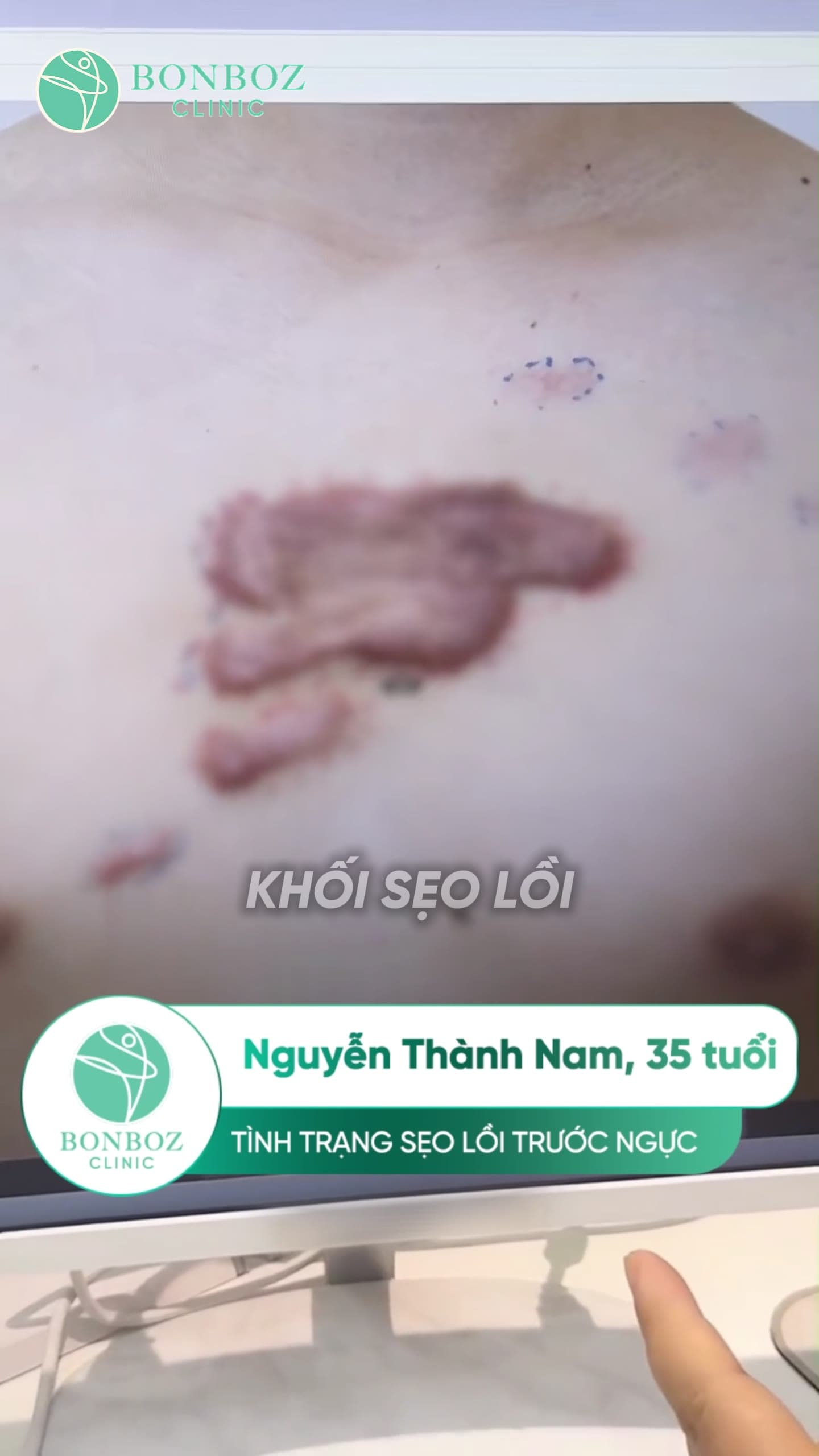 Video điều trị 07