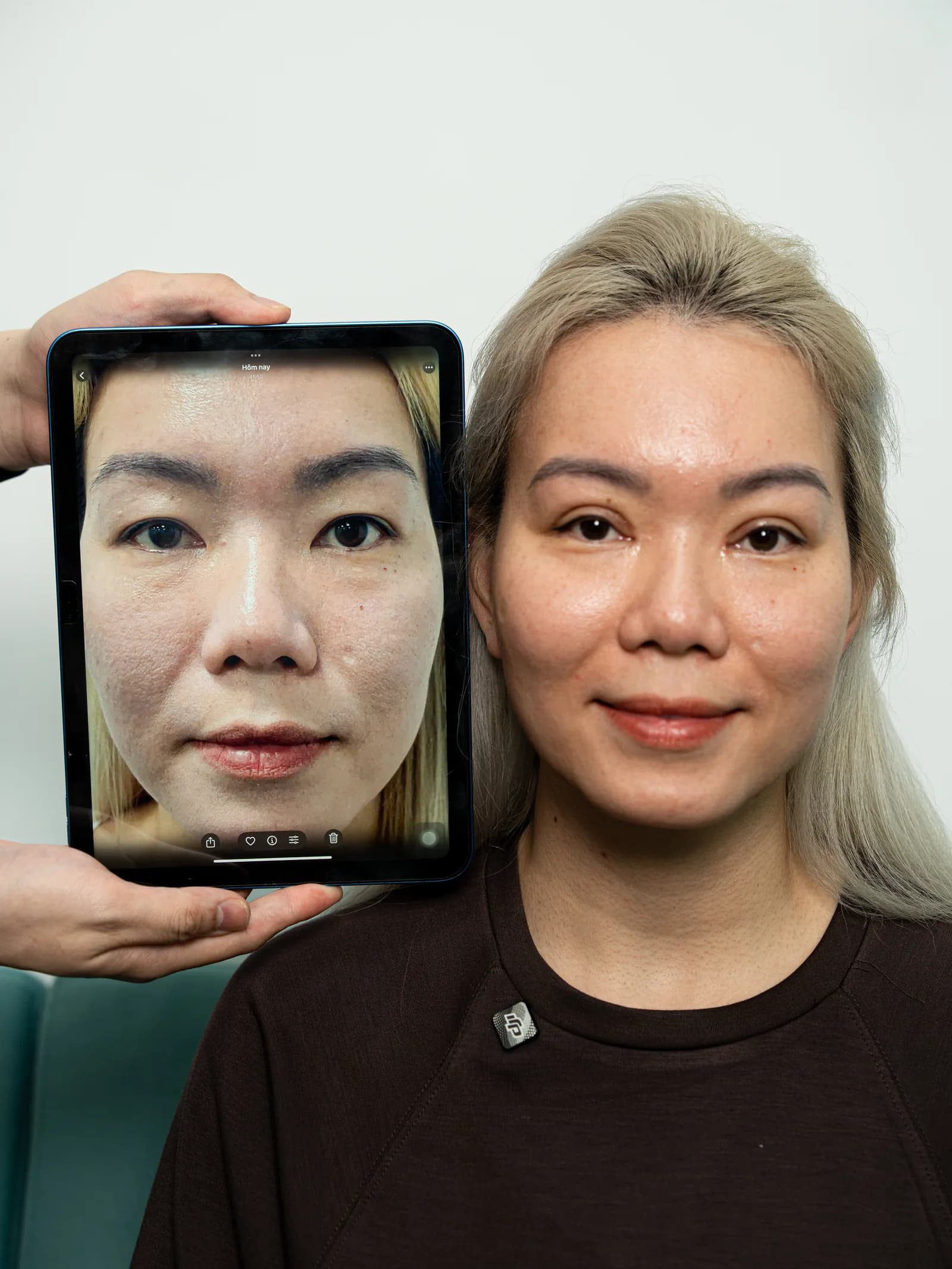 眼部手术后的顾客手持术前照片