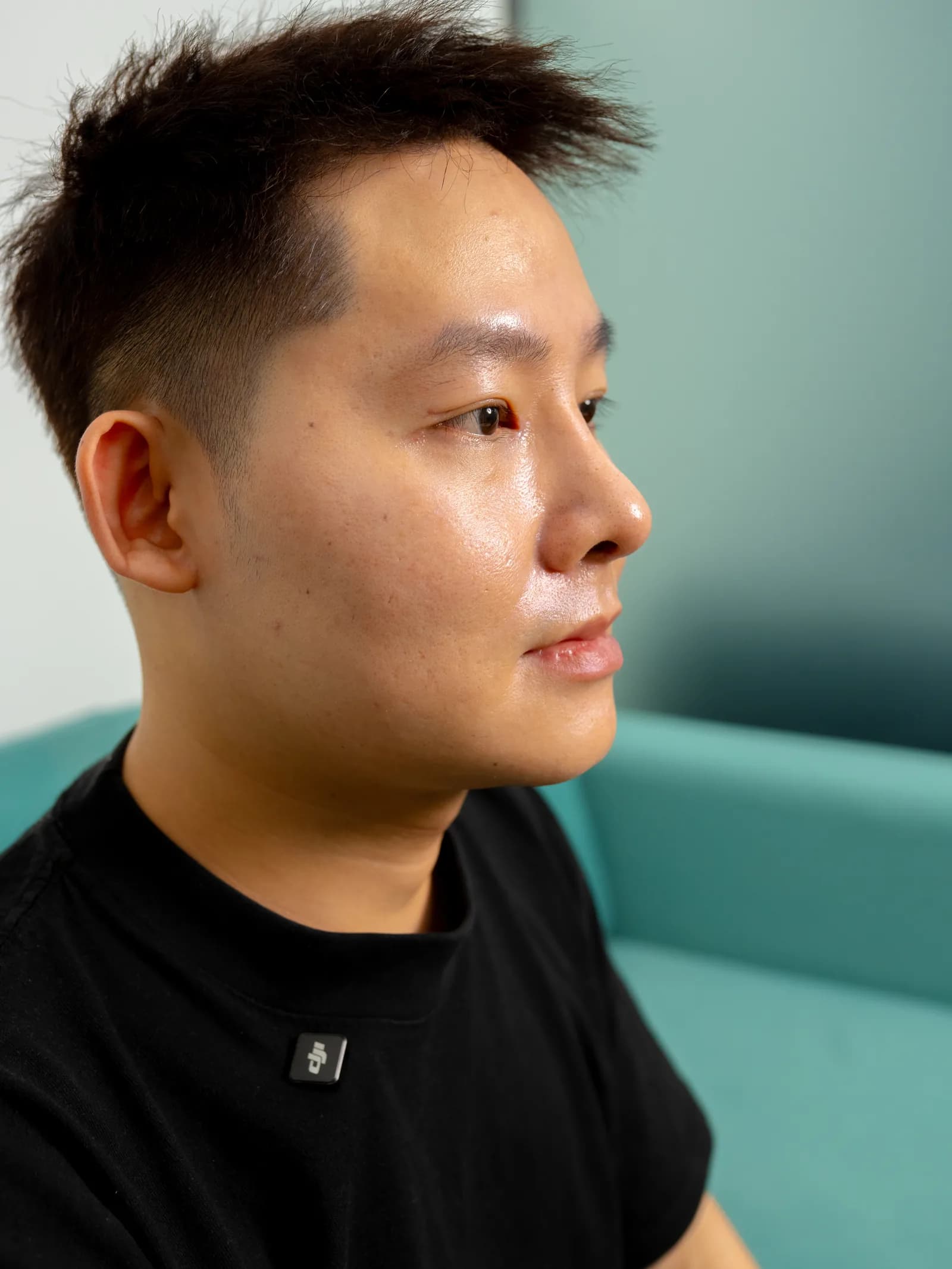 男性顾客隆鼻术后复诊,侧面照