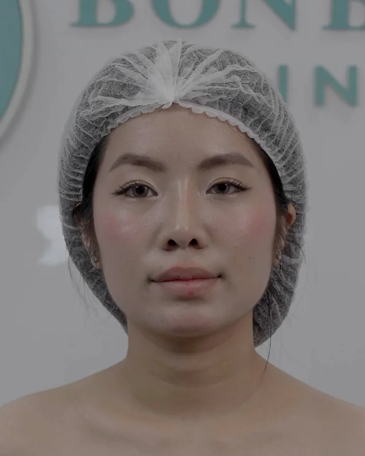 Trước — Thẩm mỹ nội khoa