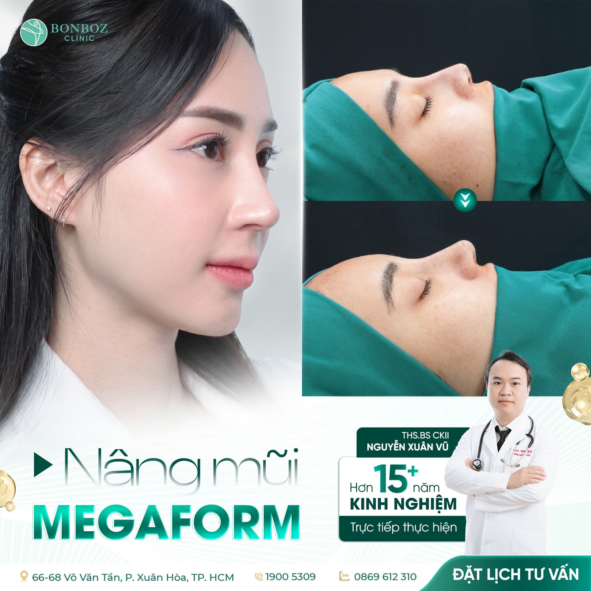 Kết quả nâng mũi Megaform thực hiện tại BonBoz