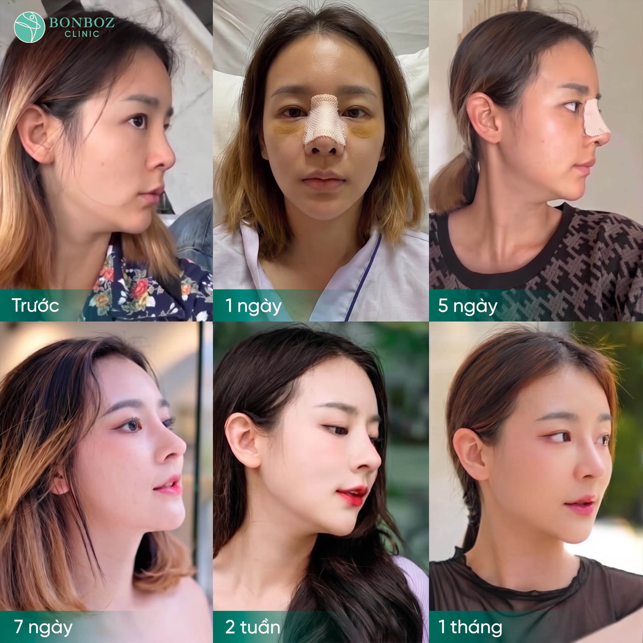 Hành trình hồi phục: từ ngày đầu đến 1 tháng sau nâng mũi