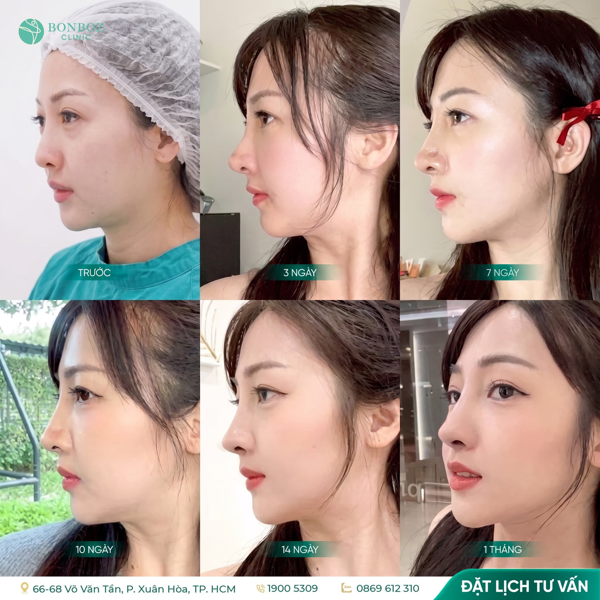 Theo dõi hồi phục sau nâng mũi qua từng mốc thời gian