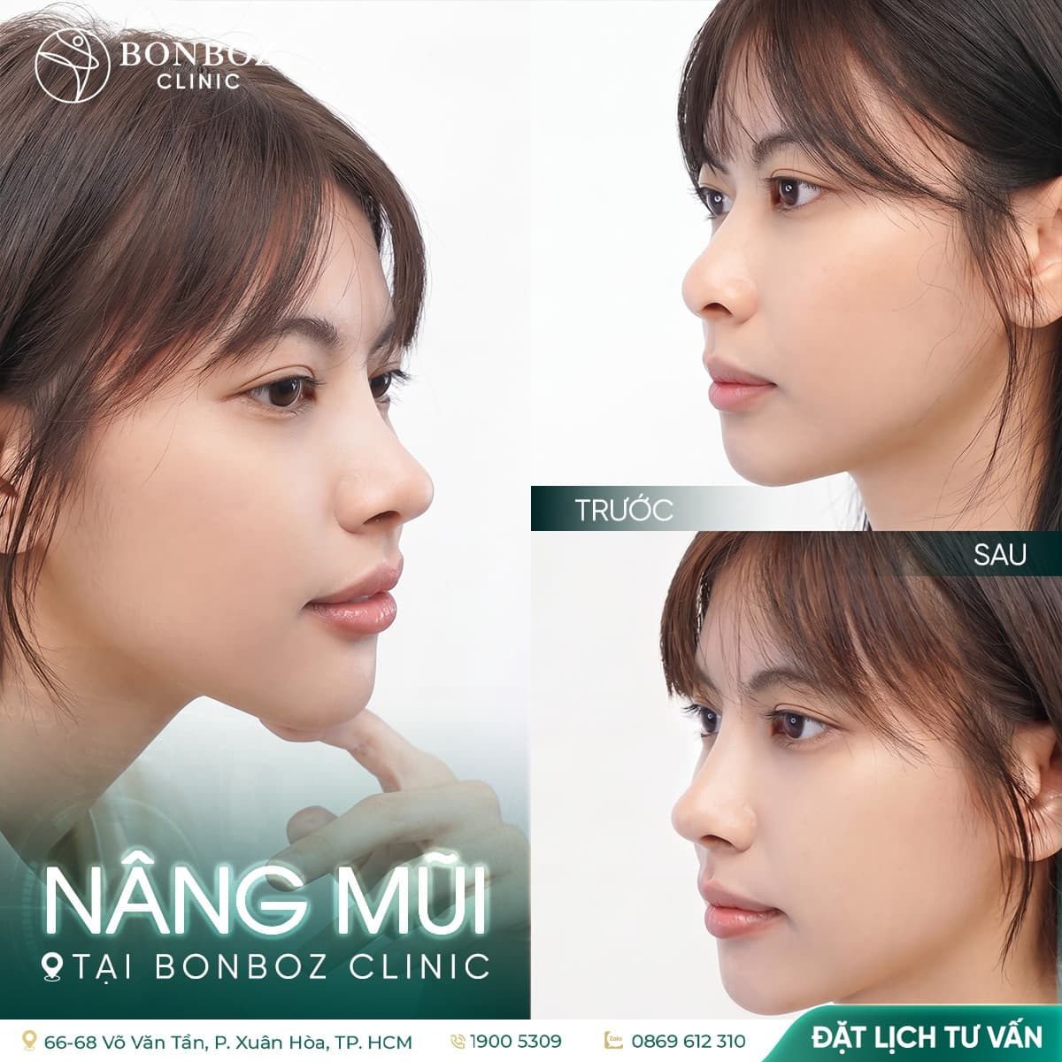 So sánh trước và sau nâng mũi tại BonBoz