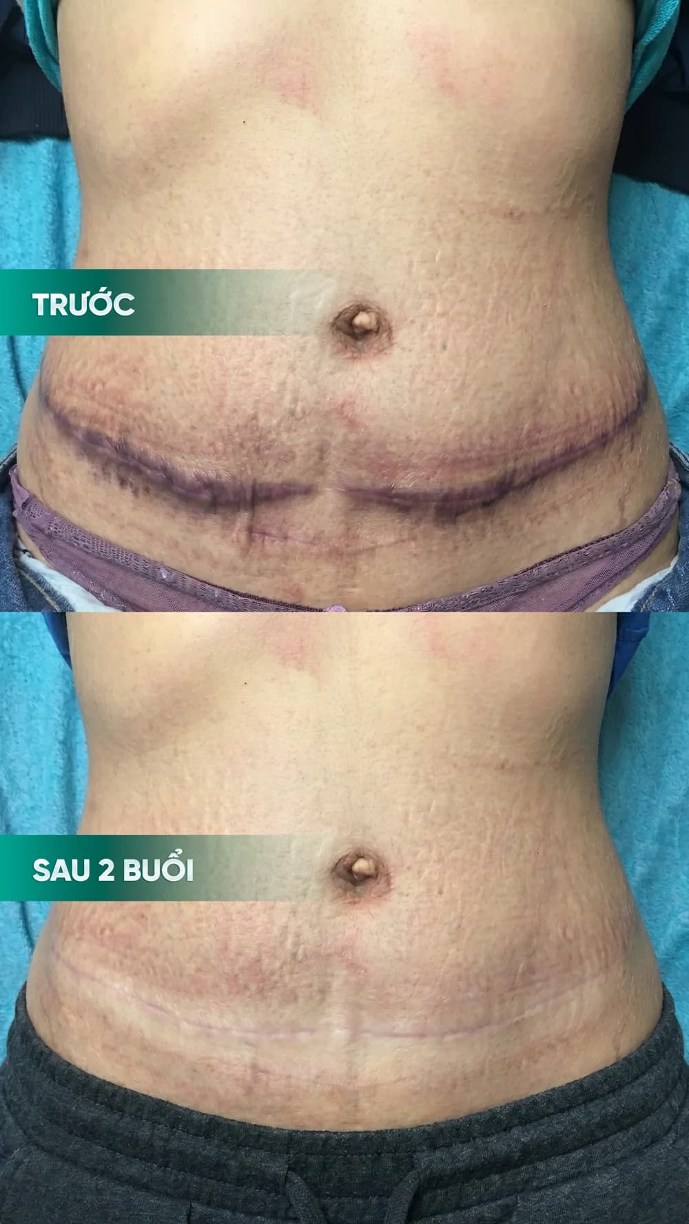 Hình ảnh trước và sau điều trị sẹo — hồ sơ 01, tư liệu do BonBoz Clinic cung cấp