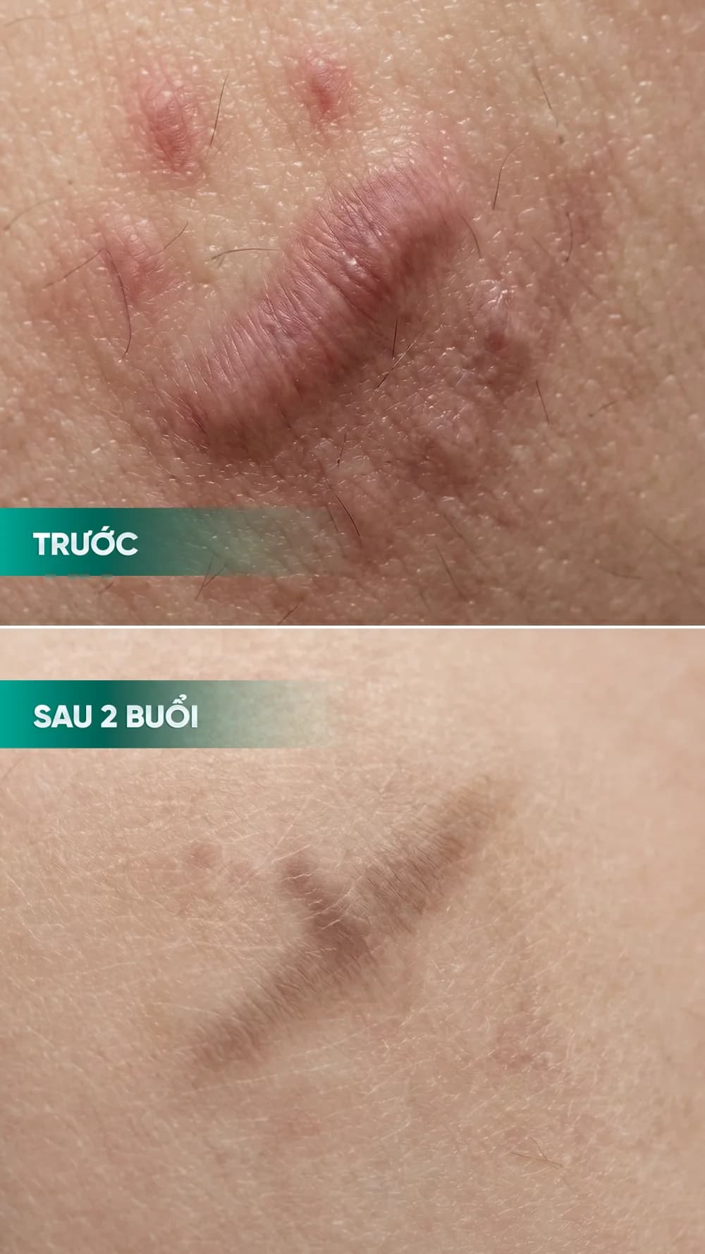 Hình ảnh trước và sau điều trị sẹo — hồ sơ 02, tư liệu do BonBoz Clinic cung cấp