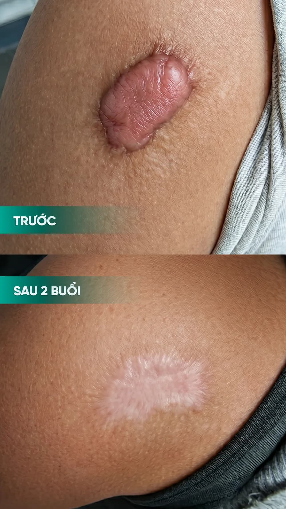 Hình ảnh trước và sau điều trị sẹo — hồ sơ 03, tư liệu do BonBoz Clinic cung cấp