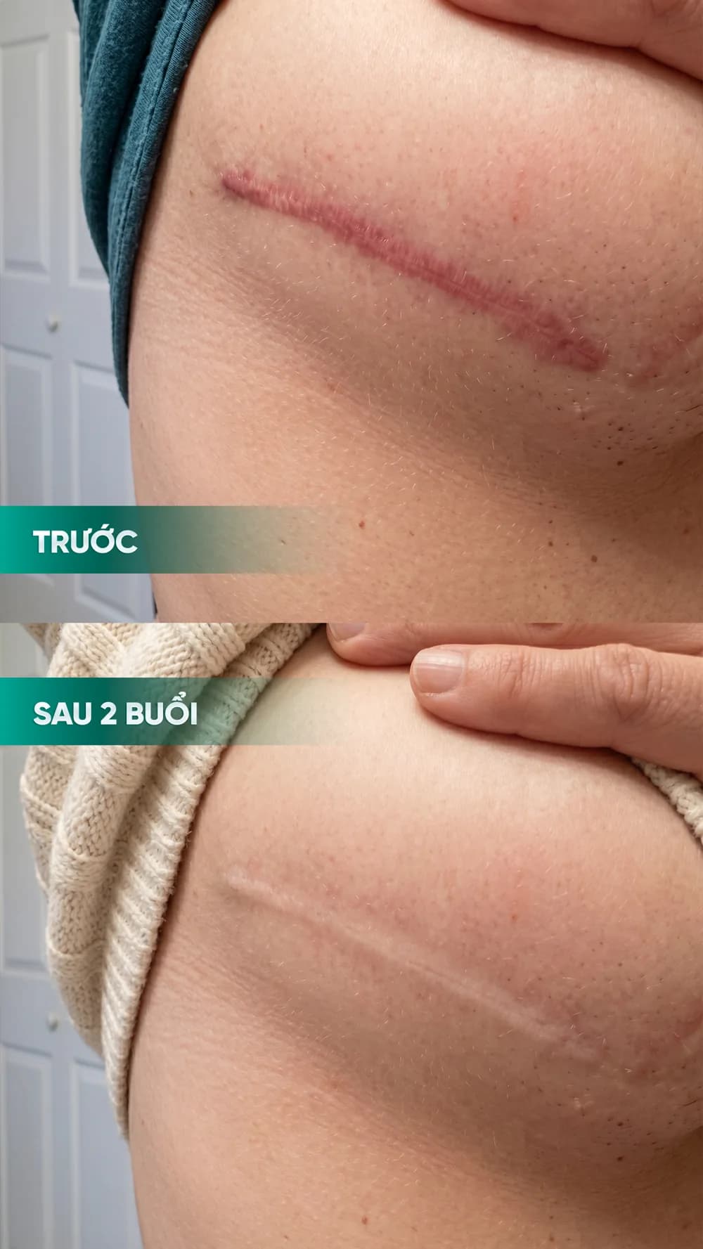 Hình ảnh trước và sau điều trị sẹo — hồ sơ 04, tư liệu do BonBoz Clinic cung cấp