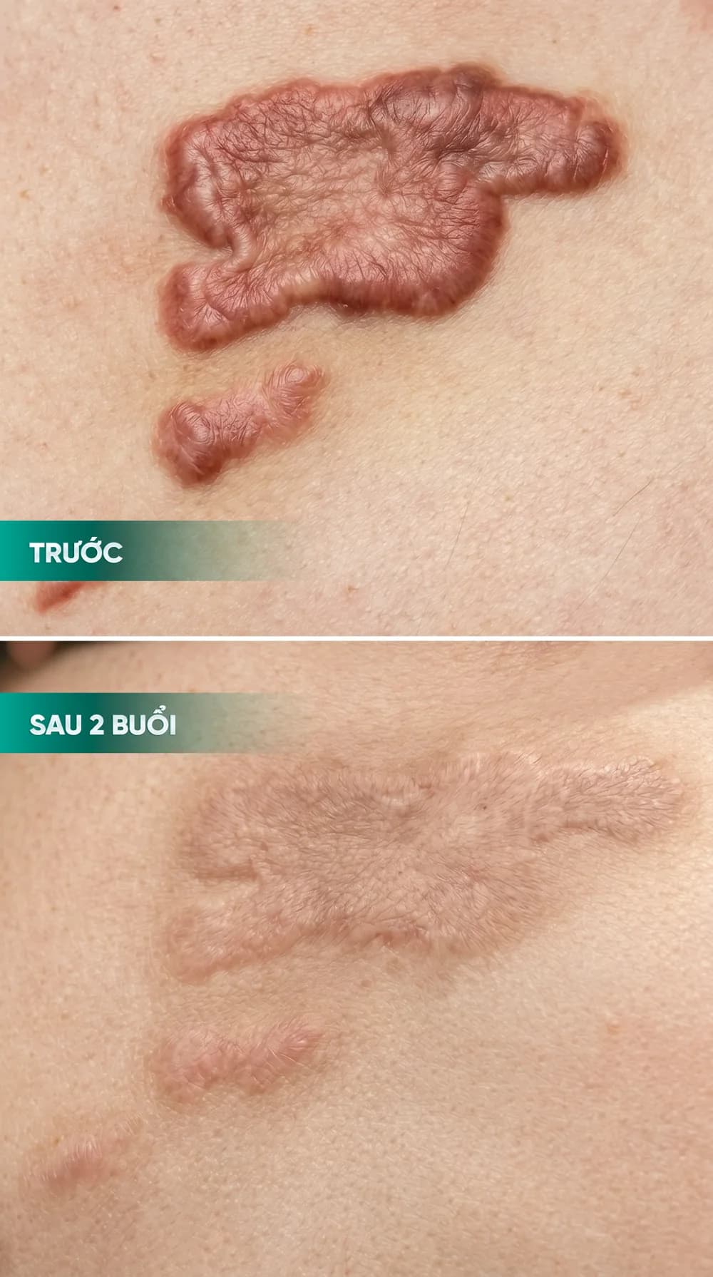 Hình ảnh trước và sau điều trị sẹo — hồ sơ 05, tư liệu do BonBoz Clinic cung cấp