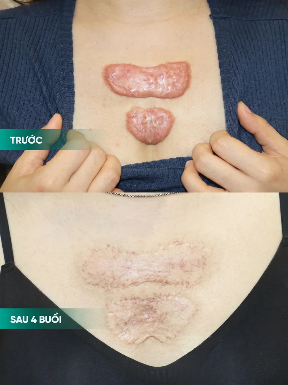 Hình ảnh trước và sau điều trị sẹo — hồ sơ 06, tư liệu do BonBoz Clinic cung cấp