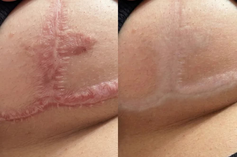 Hình ảnh trước và sau điều trị sẹo — hồ sơ 07, tư liệu do BonBoz Clinic cung cấp