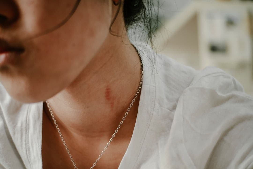 Sẹo Rỗ Do Mụn Có Tự Đầy Lại Theo Thời Gian Không?