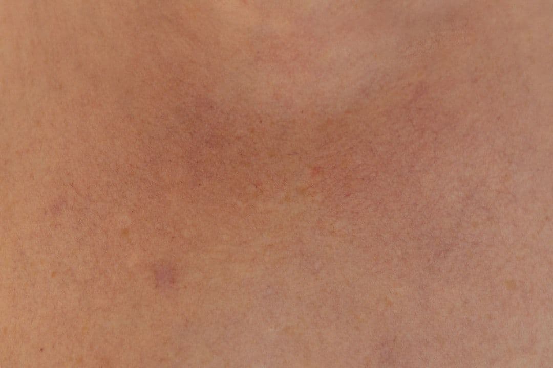 Chăm sóc da sau nặn mụn tại spa: Bí quyết tránh thâm sẹo