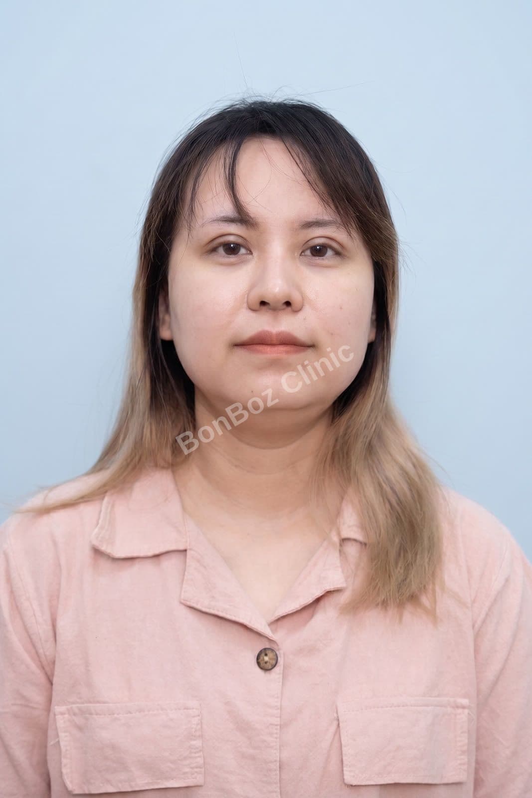 After — Eye Surgery / Eyelid Surgery