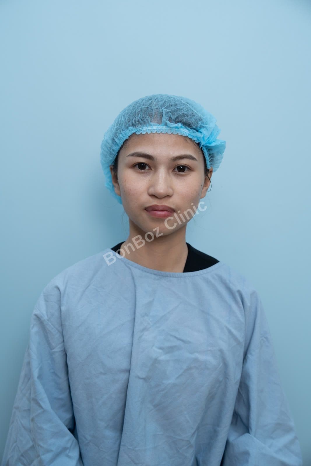 Before — Eye Surgery / Eyelid Surgery