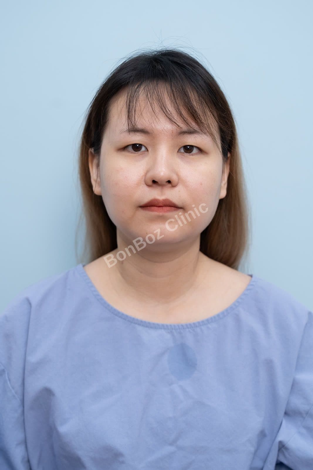 Before — Eye Surgery / Eyelid Surgery