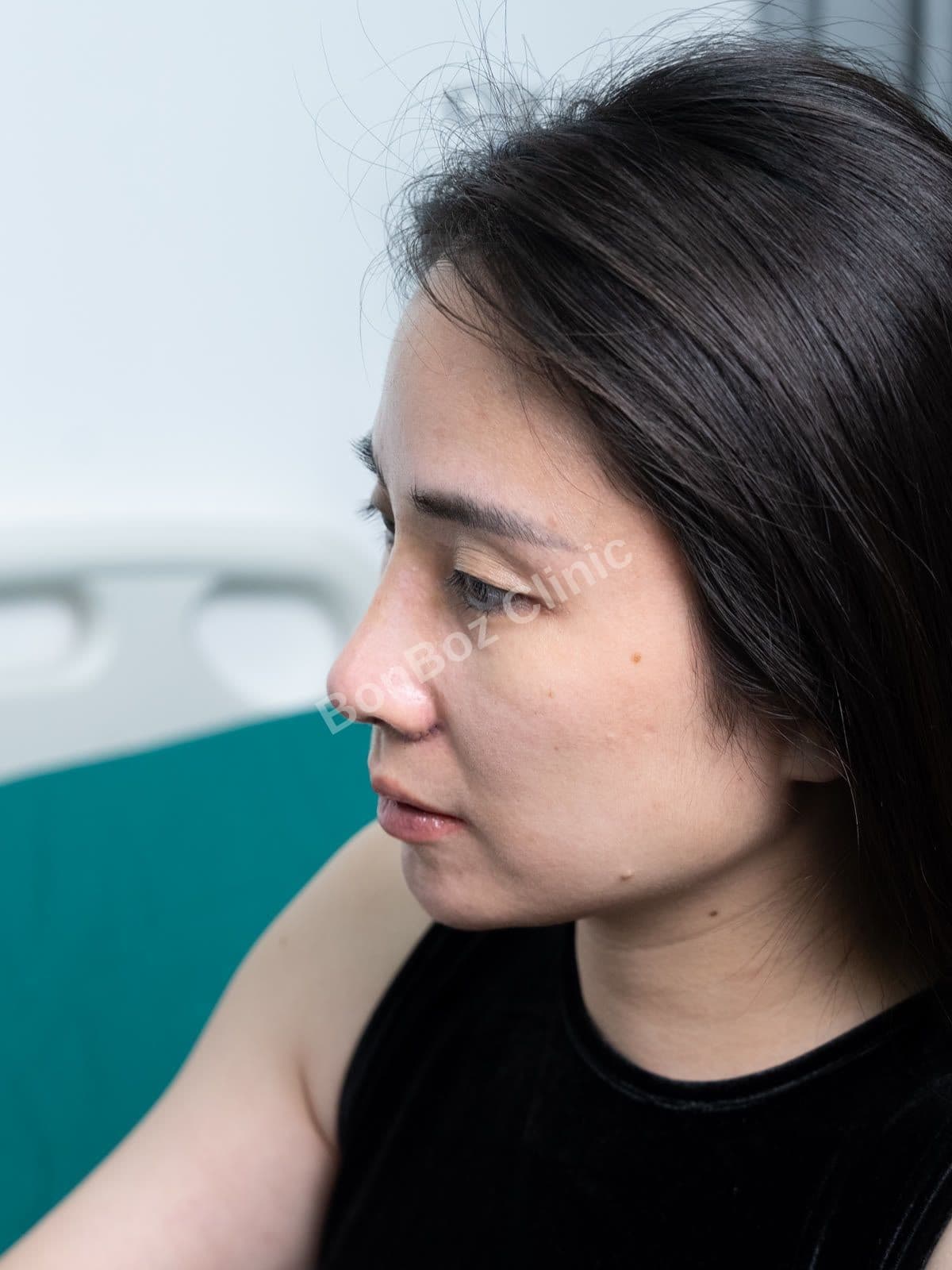 After — Rhinoplasty