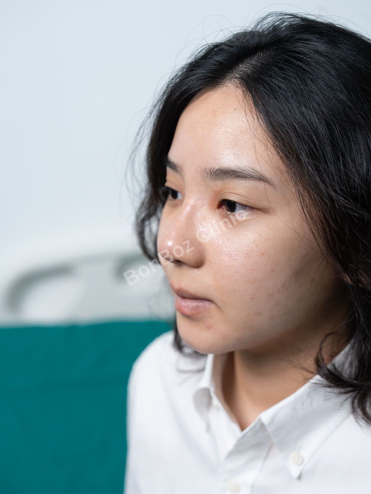 After — Rhinoplasty