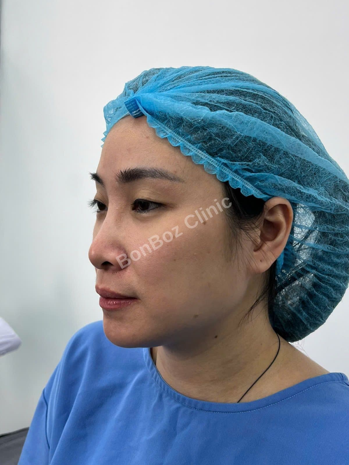 Before — Rhinoplasty