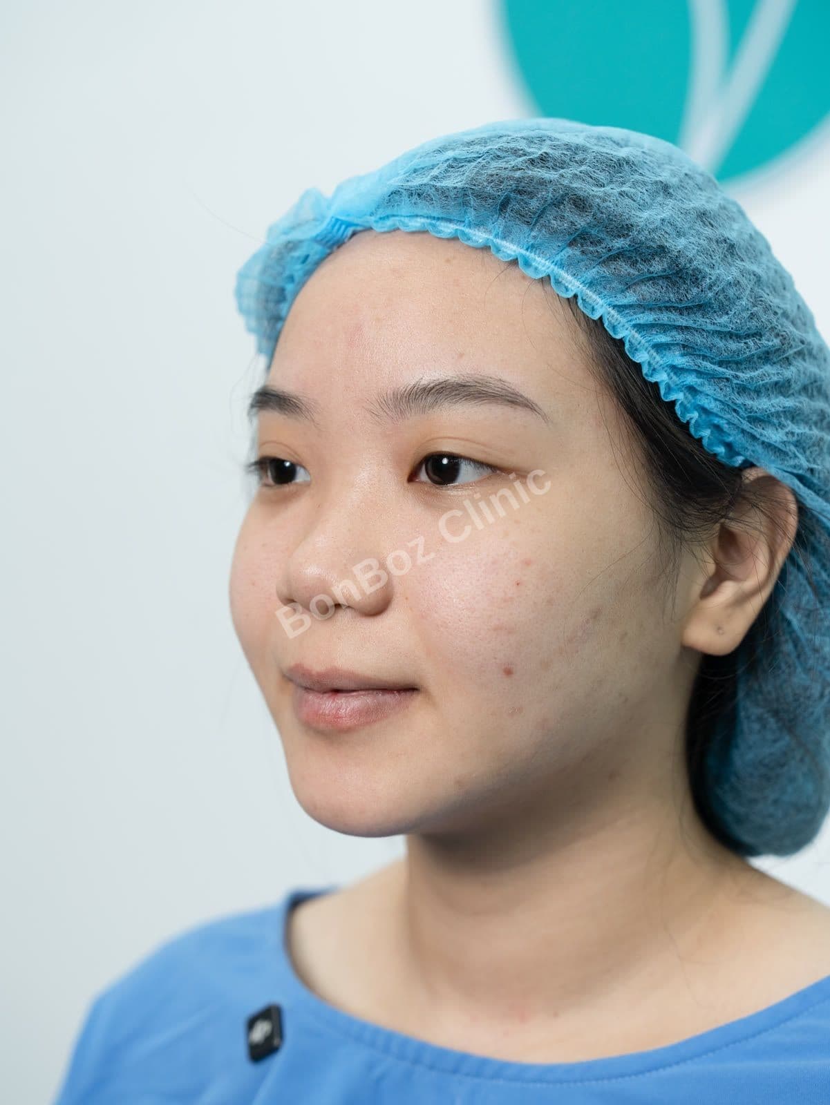 Before — Rhinoplasty