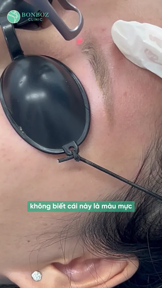 Ảnh minh hoạ — khách đeo tấm che mắt khi người thực hiện chiếu laser xoá xăm chân mày tại BonBoz Clinic