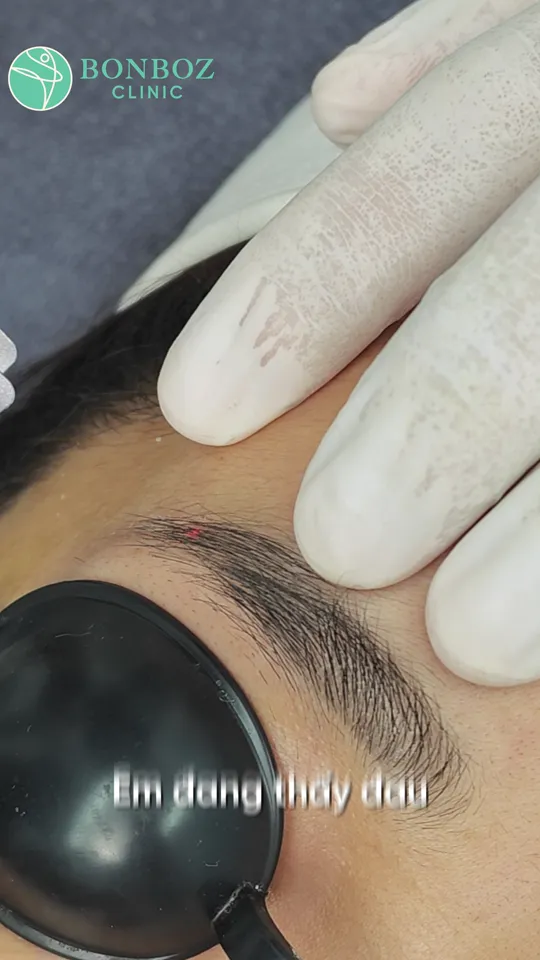Ảnh minh hoạ — khách đeo tấm che mắt, người thực hiện đeo găng giữ da trong lúc chiếu laser xoá xăm chân mày tại BonBoz Clinic